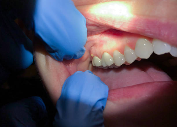 Best Emergency Dentist for Knocked-Out Tooth in Beech Island, SC